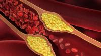 Jeder dritte Deutsche hat einen überhöhten Cholesterinspiegel.