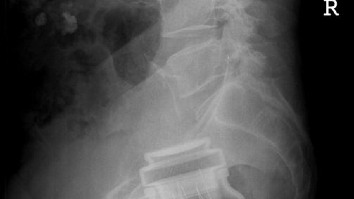 Dieser Patient befriedigte seinen Wunsch nach einer Kaffeedose im Hintern. (Foto)