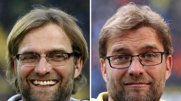 BVB-Trainer Jürgen Klopp hat sich einer Haartransplantation unterzogen.