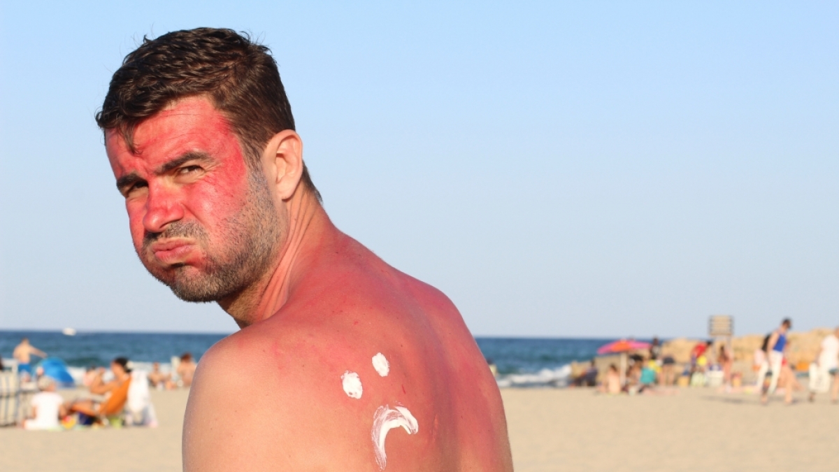 Sonnenbrand erh&ouml;ht das Krebsrisiko. (Foto)