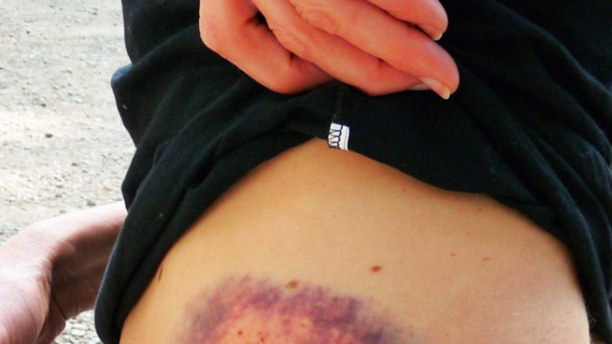 Schon mal an der T&uuml;rklinke gesto&szlig;en? Nicht nur dieser Fehltritt hinterl&auml;sst oft h&auml;ssliche blaue Flecken am K&ouml;rper. (Foto)