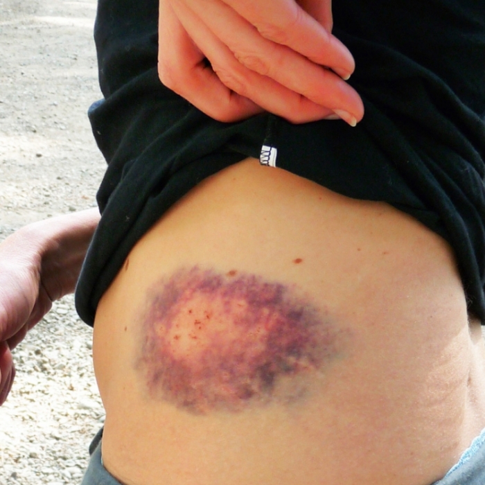 Weg mit dem blauen Fleck! Was hilft gegen Hämatome? 