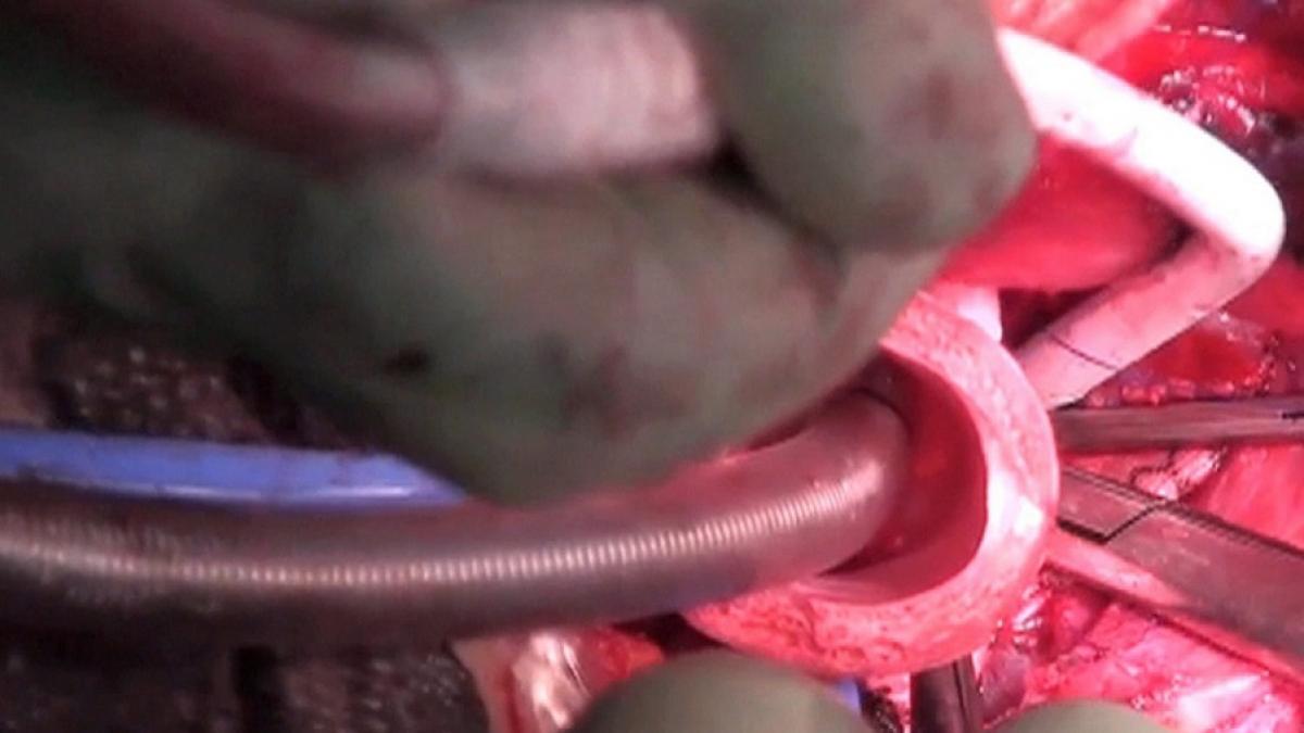 Der&nbsp;Ex-Chirurg Paolo Macchiarini wurde nach der Transplantation k&uuml;nstlicher Luftr&ouml;hren nun in Schweden verurteilt. (Foto)