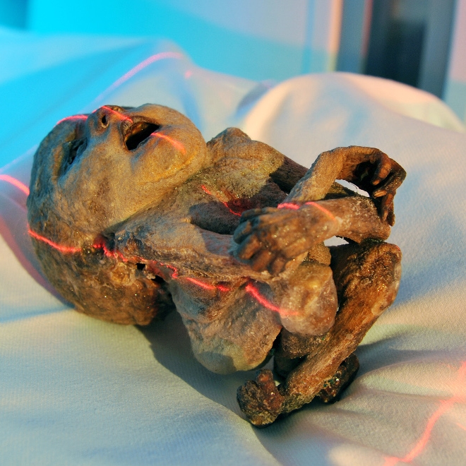 Frau lebt 50 Jahre mit mumifiziertem Fötus im Bauch