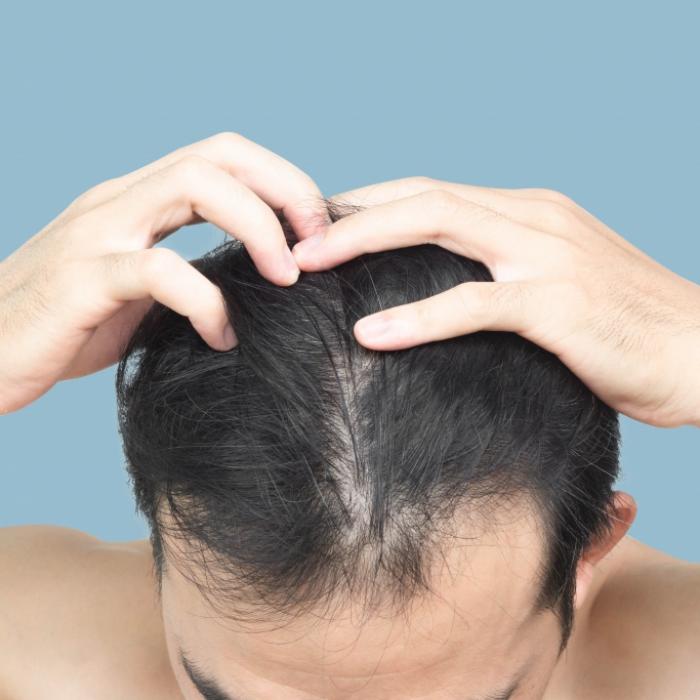 Beliebte Softdrinks führen bei Männern zu Haarverlust