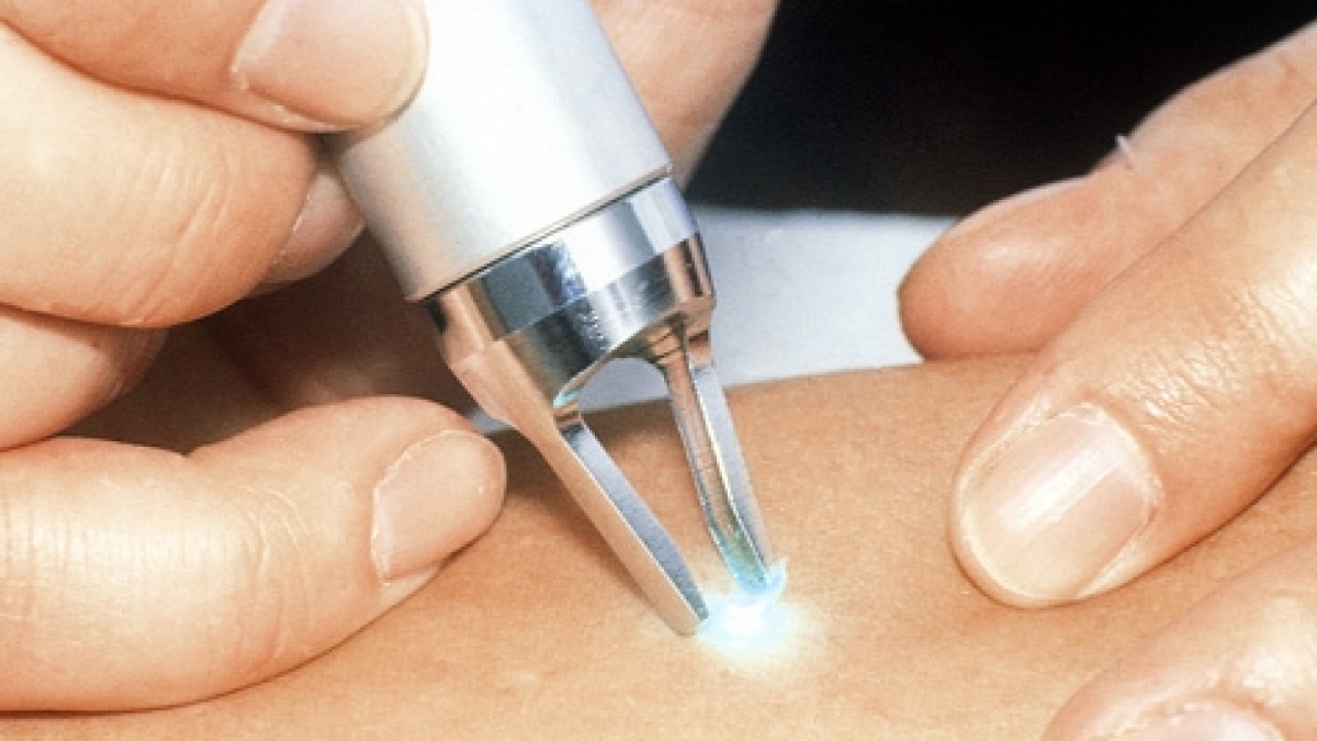 Besenreiser lassen sich durch Laser entfernen. Sie k&ouml;nnen Vorboten f&uuml;r Krampfadern sein. (Foto)