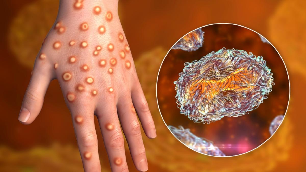 Die 3D-Illustration zeigt die Hand eines Affenpocken-Patienten. (Foto)