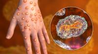 Die 3D-Illustration zeigt die Hand eines Affenpocken-Patienten.