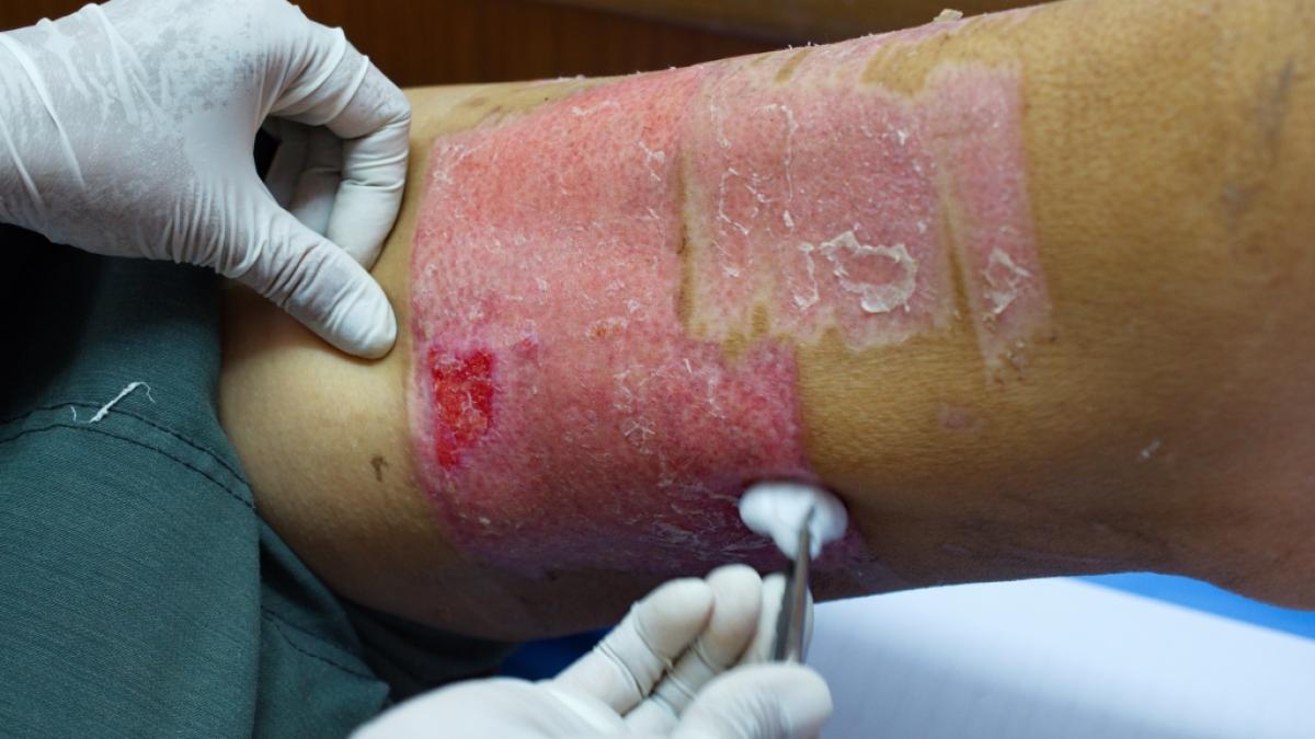 Eine 51-J&auml;hrige aus Australien wurde durch eine Hauttransplantation im letzten Moment vor dem sicheren Tod gerettet. (Foto)