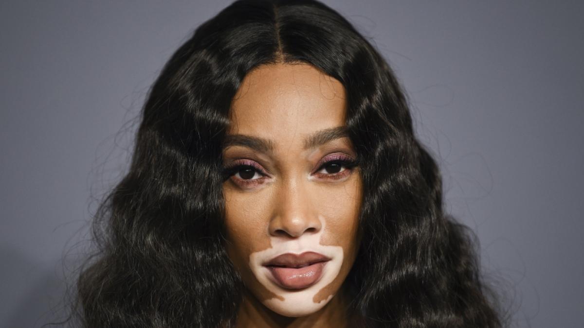 Model Winnie Harlow ist trotz ihrer Hauterkrankung als Model erfolgreich. (Foto)