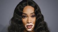 Model Winnie Harlow ist trotz ihrer Hauterkrankung als Model erfolgreich.