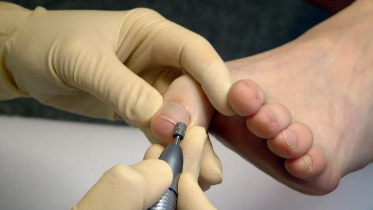 Mit einer Fr&auml;&szlig;e werden befallene Nagelschichten abgetragen. (Foto)
