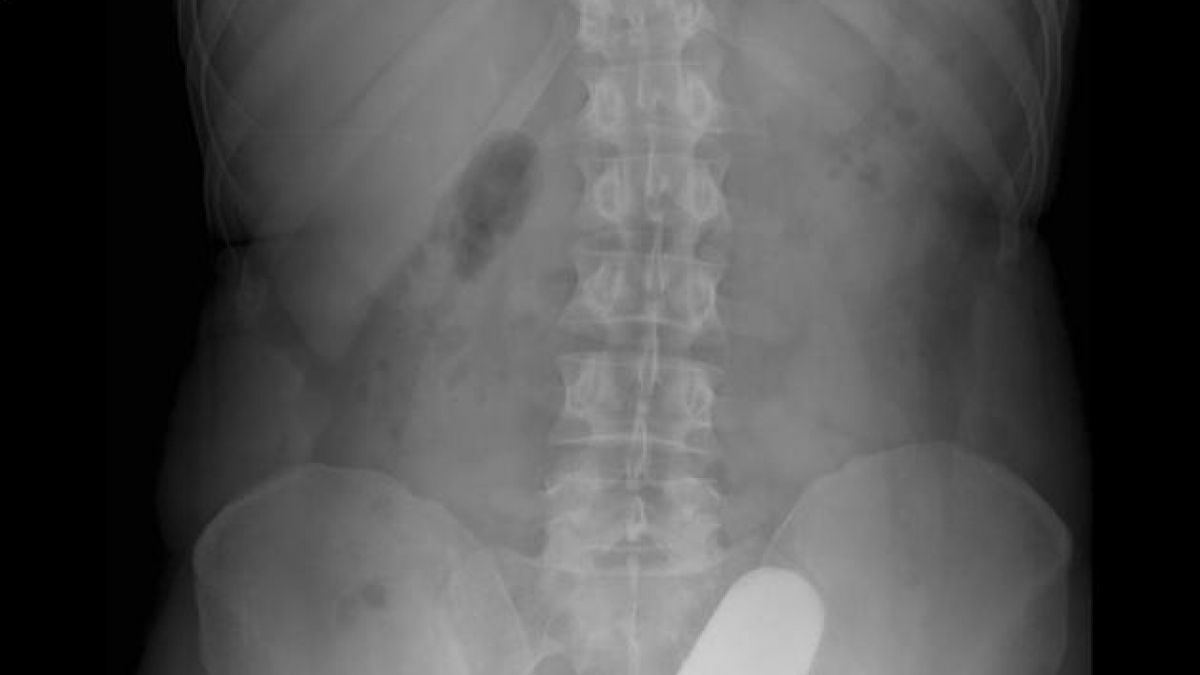 Nein, es ist kein Vibrator und auch keine Karotte: Ein St&ouml;&szlig;el hatte sich in den Anus dieses Patienten verirrt. (Foto)