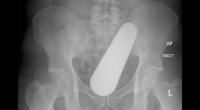 Nein, es ist kein Vibrator und auch keine Karotte: Ein Stößel hatte sich in den Anus dieses Patienten verirrt.
