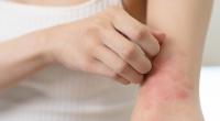 Rötungen und juckende Stellen können mitunter auf Diabetes hinweisen.