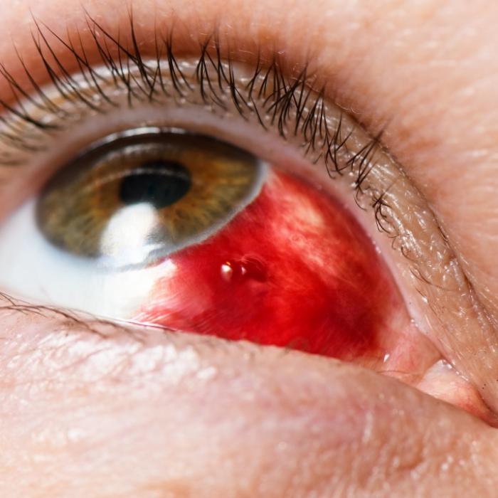 Sonnenbrand im Auge! SO schützen Sie Ihr Augenlicht