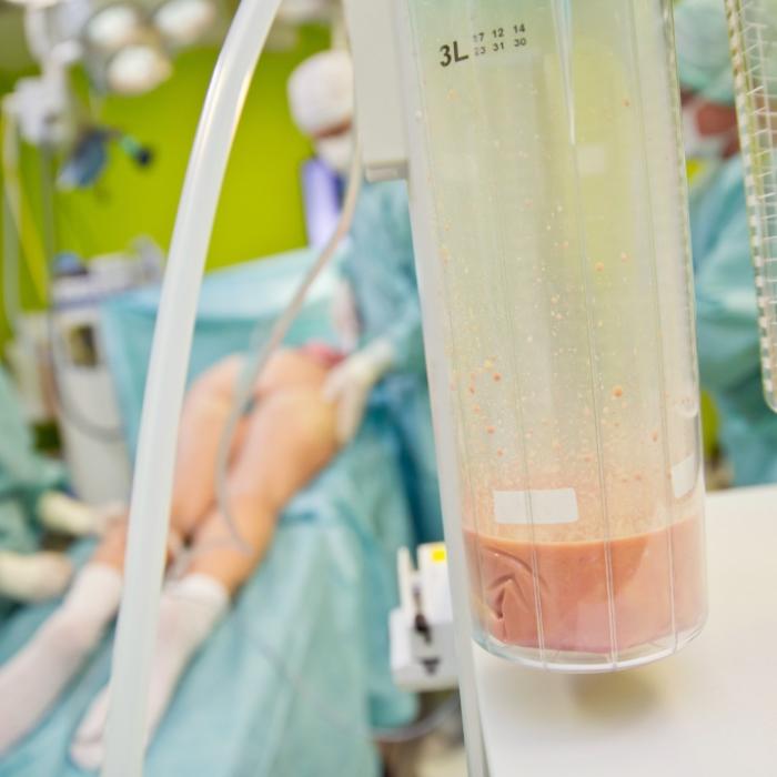Arzt pumpt Frau 12 Liter Fett aus den Armen ab