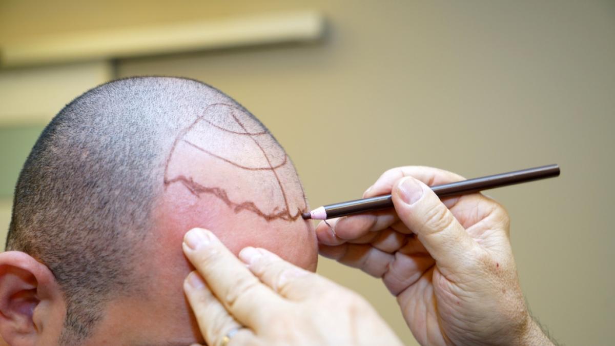 In der T&uuml;rkei sind Haartransplantationen oftmals g&uuml;nstiger als in Deutschland. (Foto)