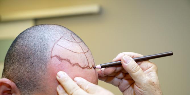 Top 10 beste Haartransplantation Kliniken Türkei 2026
