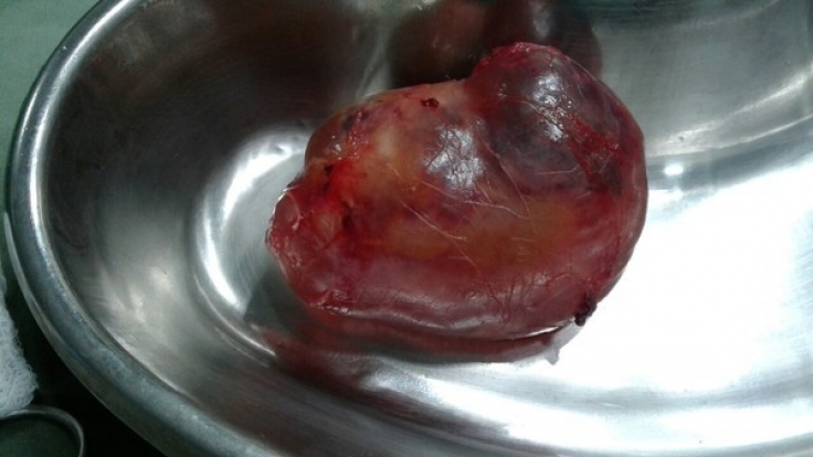 Der teilentwickelte Foetus ist ca. sieben Zentimeter lang und wiegt 150 Gramm.