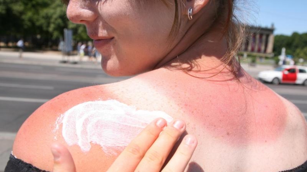 Autsch, ein Sonnenbrand! Doch die Behandlung mit Hausmitteln wie Quark kann b&ouml;se Folgen haben. (Foto)