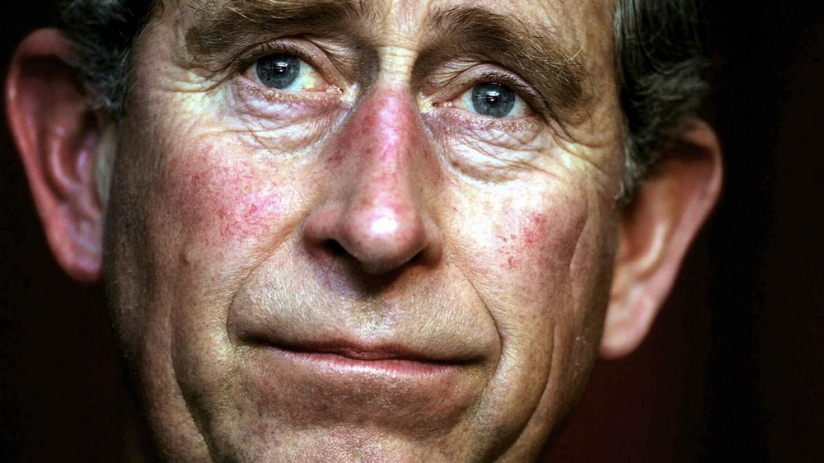 Feine durchschimmernde &Auml;derchen und R&ouml;tungen im Gesicht verraten Medizinern, dass K&ouml;nig Charles III. Rosacea-Symptome hat. (Foto)