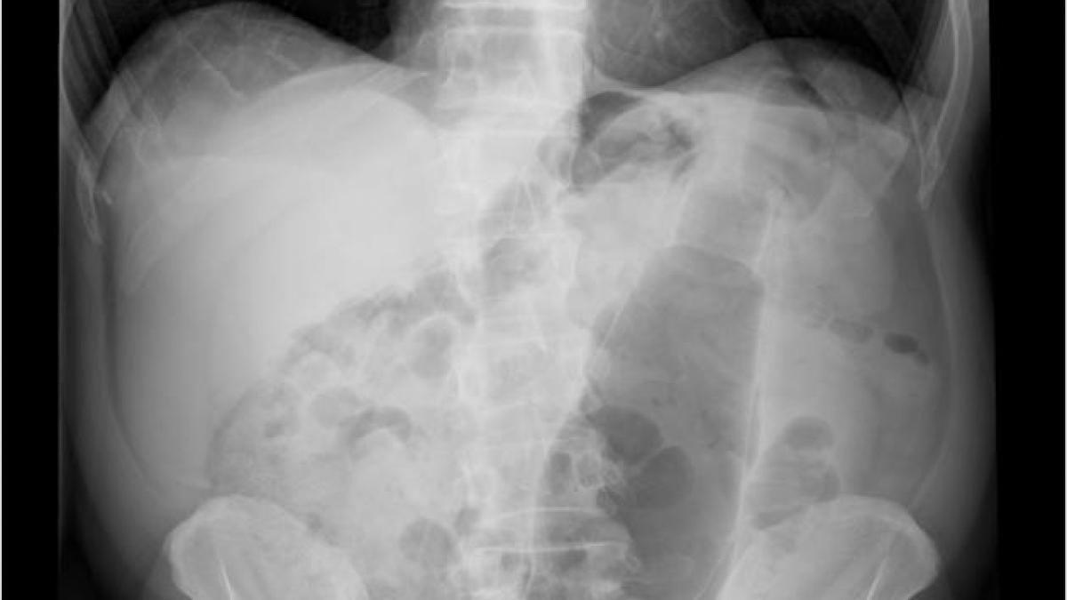 Auch gro&szlig;e Gegenst&auml;nde wie Trinkflaschen f&uuml;hren sich die Patienten ein. (Foto)