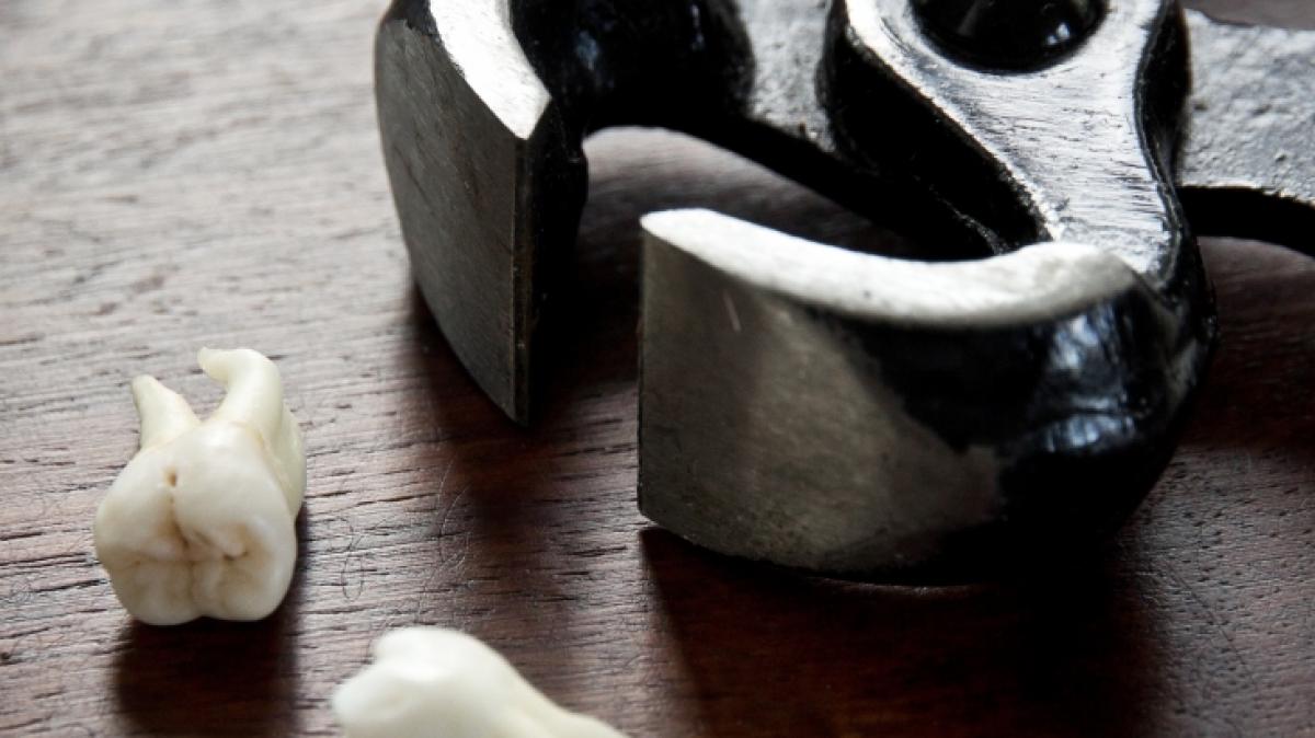 Ein Mann (50) zieht sich seine Z&auml;hne aus Verzweiflung selbst. (Foto)