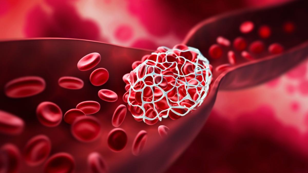 Schwedische Forscher fanden heraus, dass Covid-Patienten sechs Monate nach ihrer Infektion ein erh&ouml;htes Risiko f&uuml;r Blutgerinnsel aufwiesen. (Symbolfoto) (Foto)