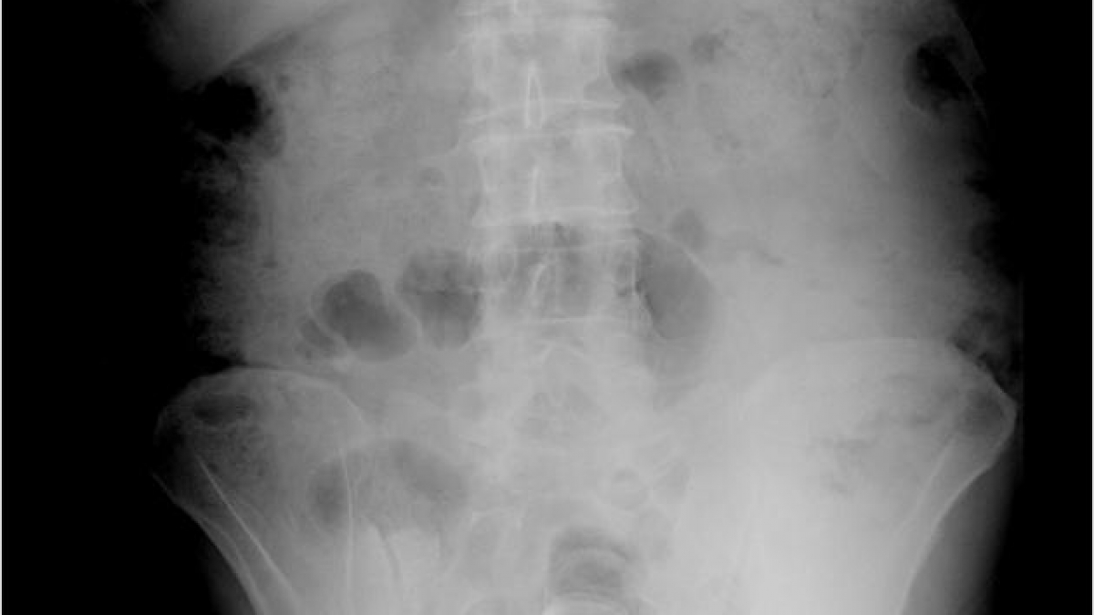 Dieser Patient wollte offenbar f&uuml;r einen guten Duft "untenrum" sorgen und steckte sich eine Deo-Flasche in den After. (Foto)