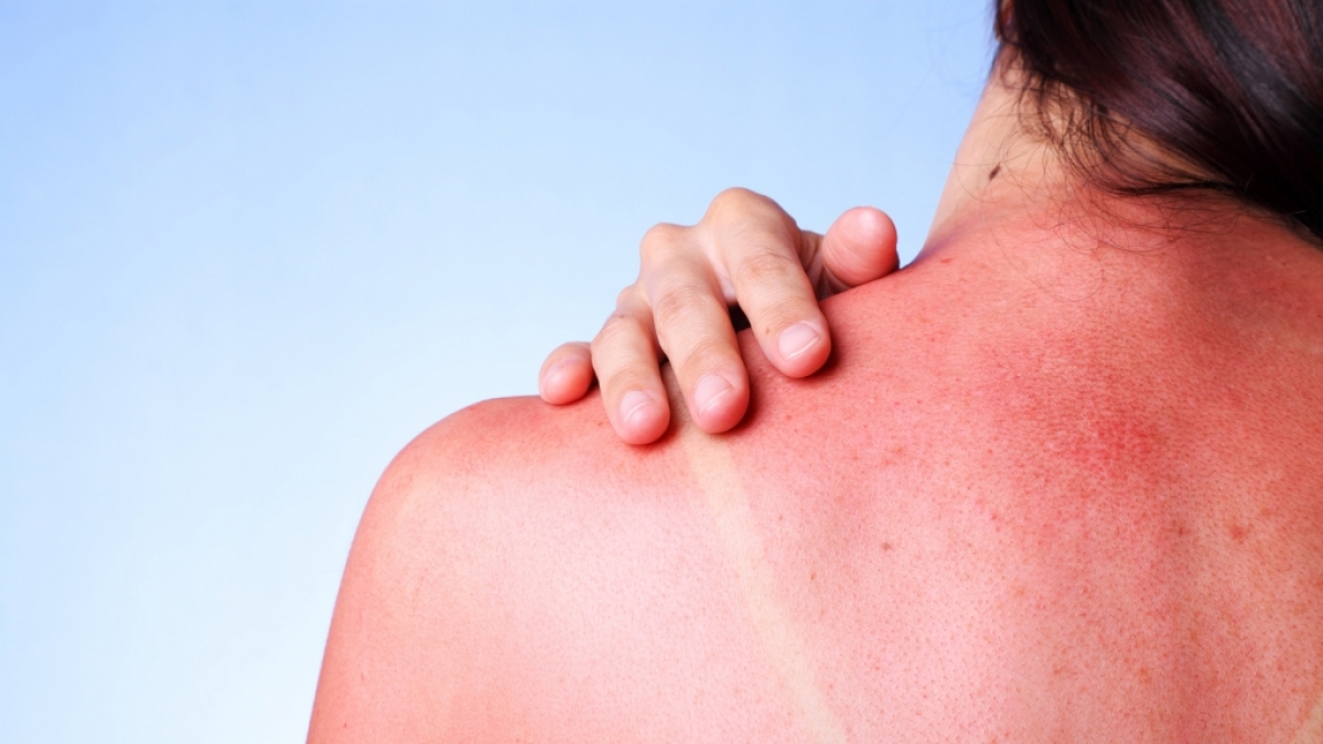 Sonnenbrand tut nicht nur weh, sondern erh&ouml;ht auch das Risiko f&uuml;r Hautkrebs. (Foto)