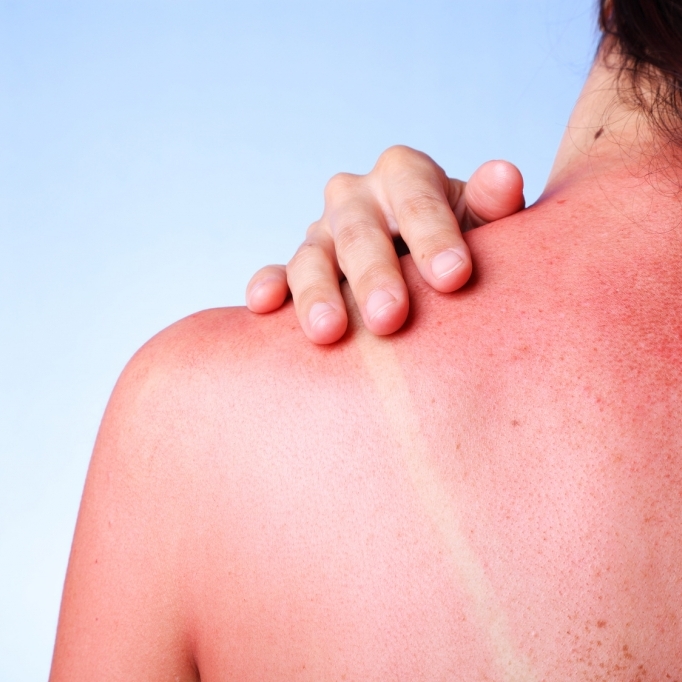 Diese Lebensmittel erhöhen die Sonnenbrandgefahr